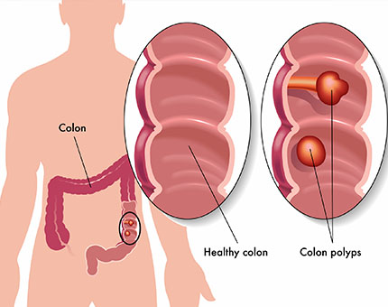 colon polyps