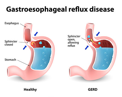 GASTROESOPHAGEAL REFLUX DISEASE