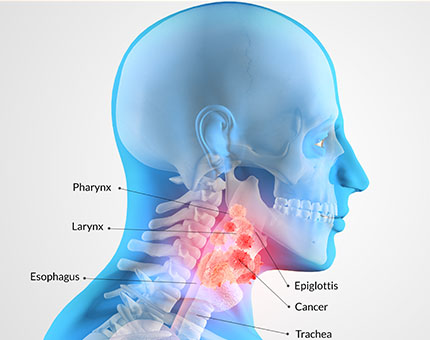 throat cancer