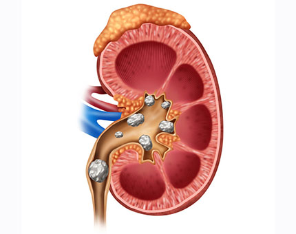 renal calculi/kidney stones